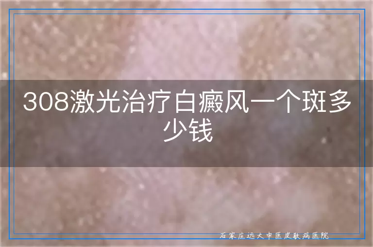 308激光治疗白癜风一个斑多少钱