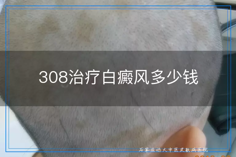 308治疗白癜风多少钱
