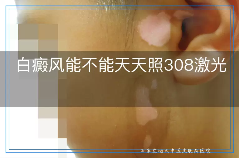 白癜风能不能天天照308激光