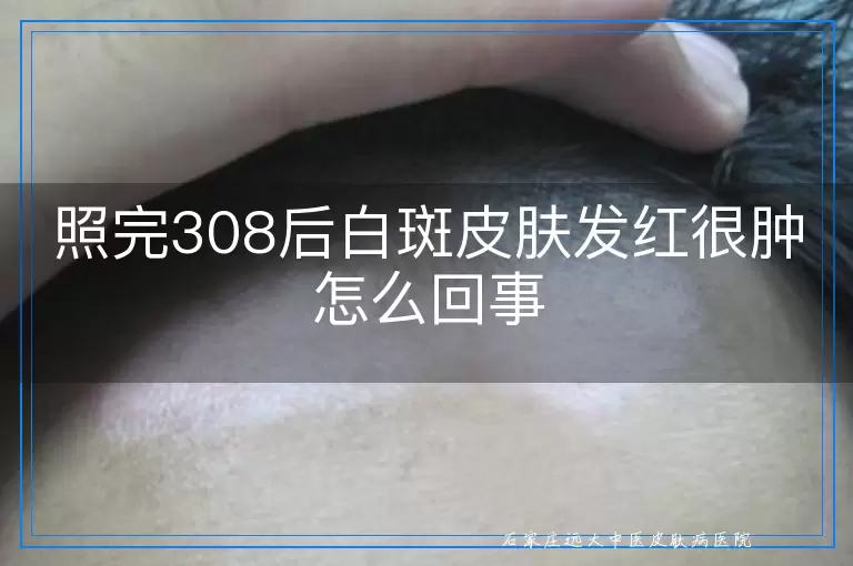 照完308后白斑皮肤发红很肿怎么回事