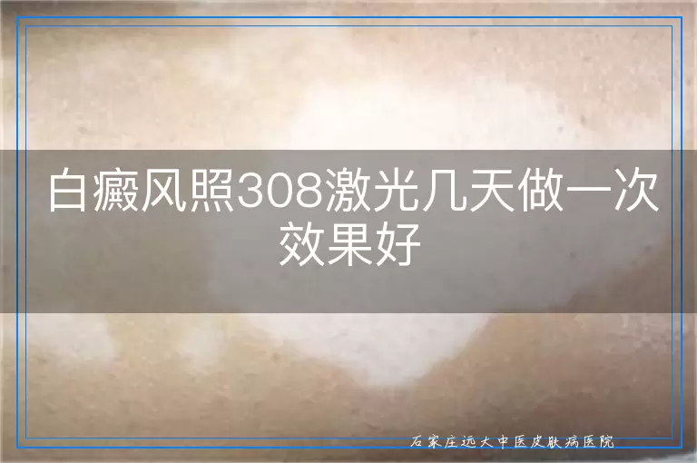 白癜风照308激光几天做一次效果好