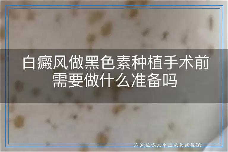 白癜风做黑色素种植手术前需要做什么准备吗