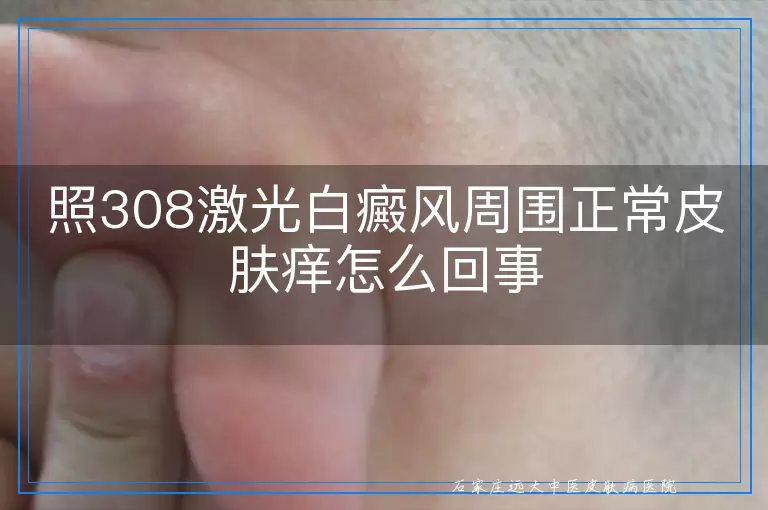 照308激光白癜风周围正常皮肤痒怎么回事