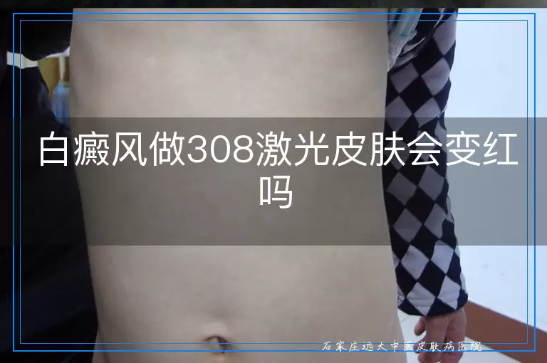 白癜风做308激光皮肤会变红吗