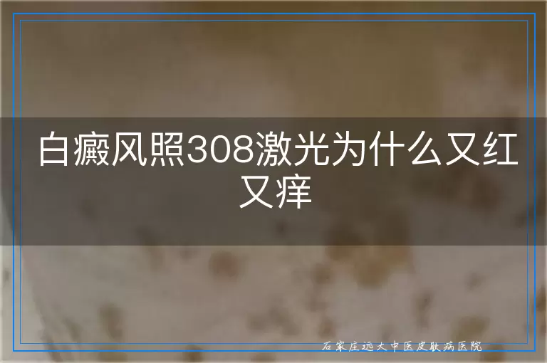 白癜风照308激光为什么又红又痒