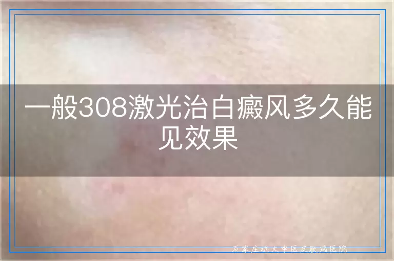 一般308激光治白癜风多久能见效果