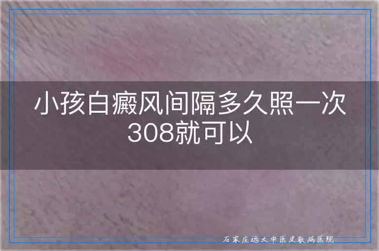 小孩白癜风间隔多久照一次308就可以