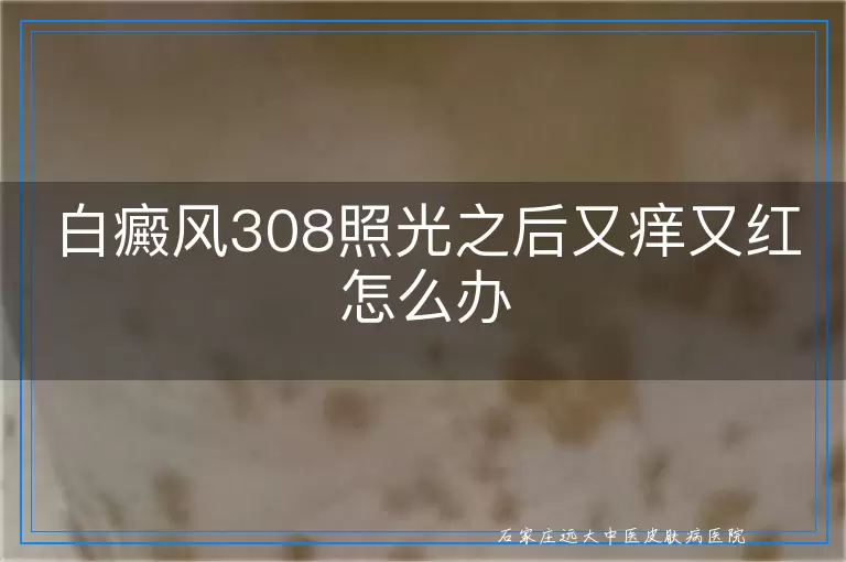 白癜风308照光之后又痒又红怎么办