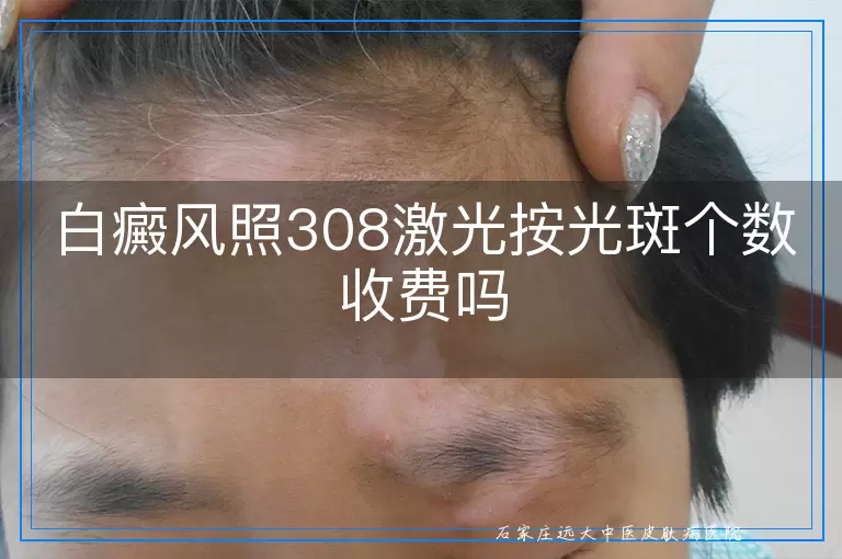 白癜风照308激光按光斑个数收费吗