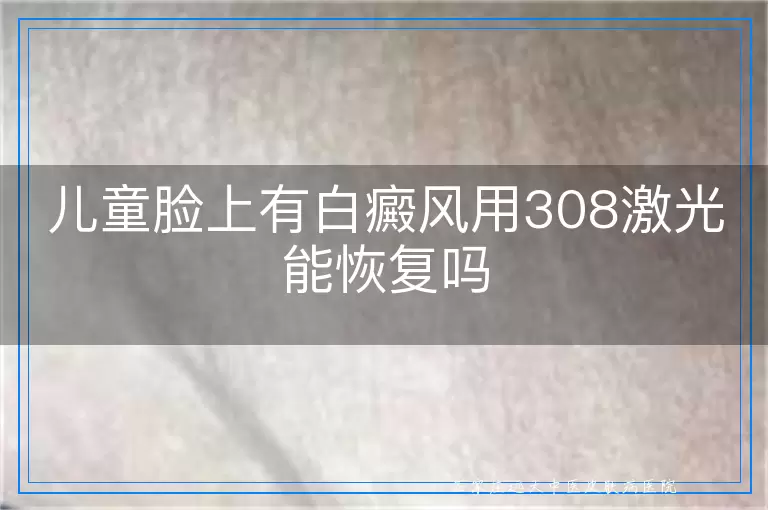 儿童脸上有白癜风用308激光能恢复吗