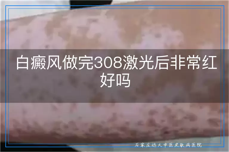 白癜风做完308激光后非常红好吗