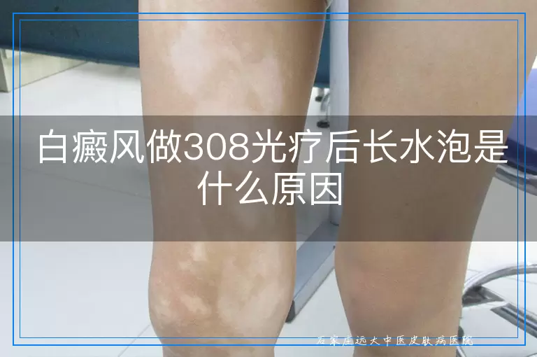 白癜风做308光疗后长水泡是什么原因