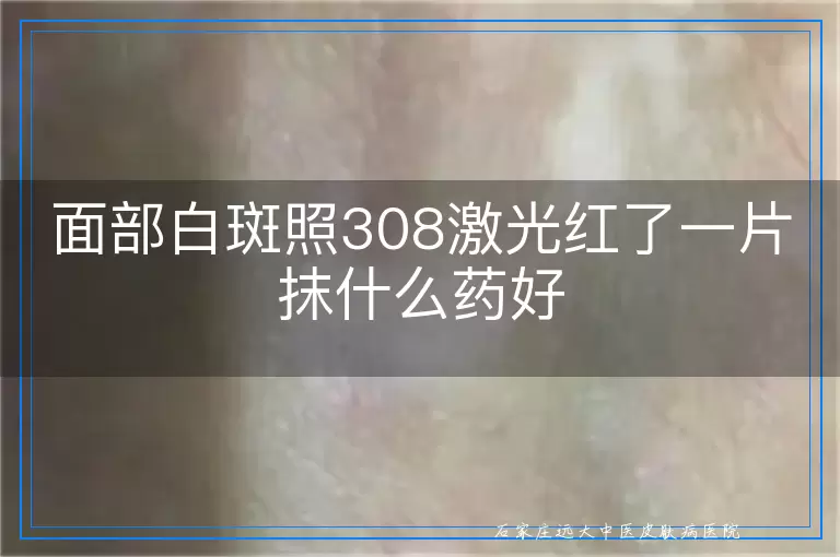 面部白斑照308激光红了一片抹什么药好