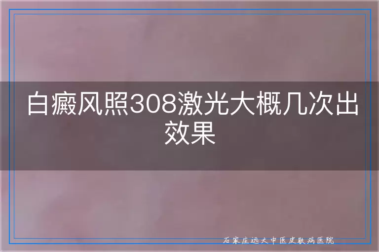 白癜风照308激光大概几次出效果