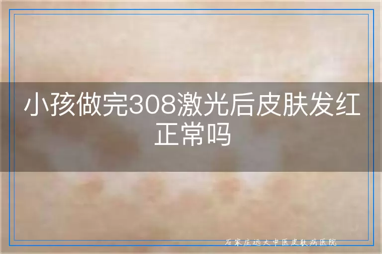 小孩做完308激光后皮肤发红正常吗