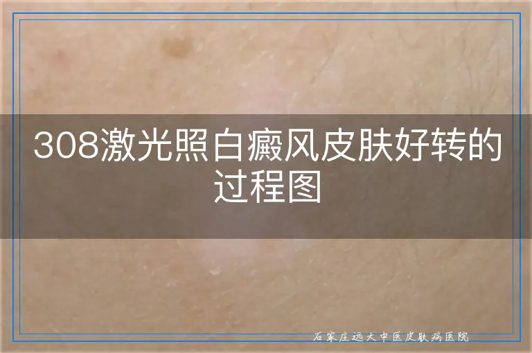 308激光照白癜风皮肤好转的过程图