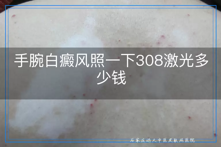 手腕白癜风照一下308激光多少钱
