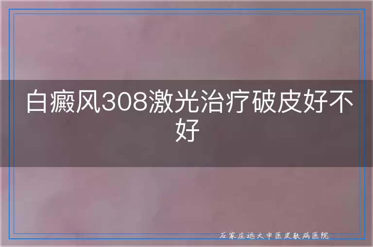 白癜风308激光治疗破皮好不好