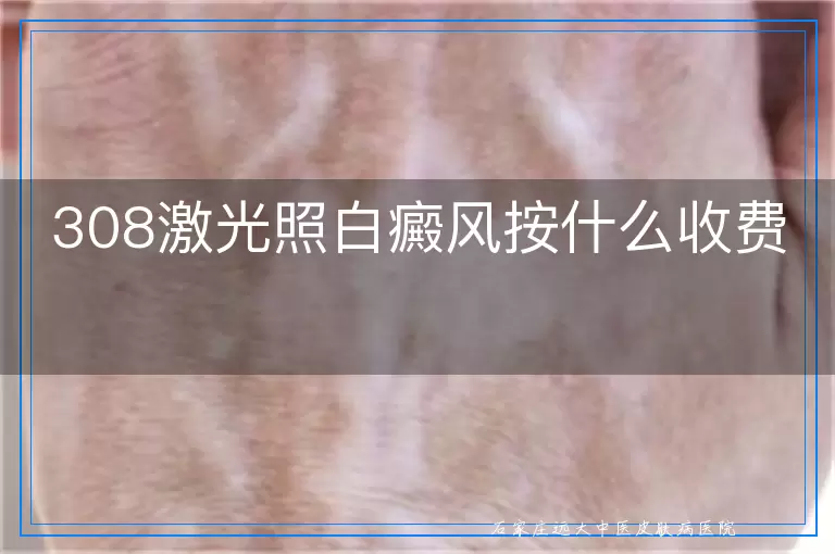 308激光照白癜风按什么收费