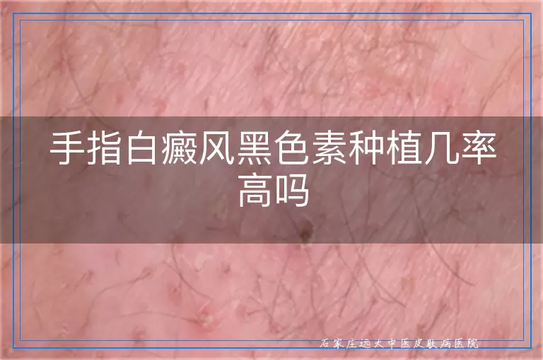 手指白癜风黑色素种植几率高吗