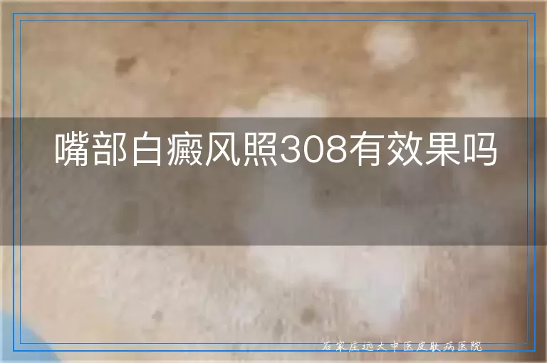 嘴部白癜风照308有效果吗