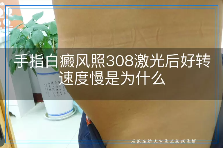 手指白癜风照308激光后好转速度慢是为什么