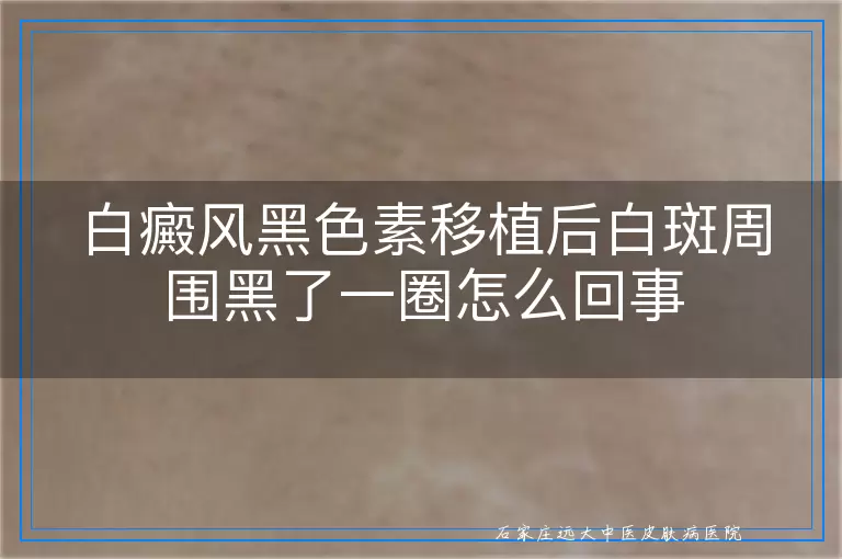 白癜风黑色素移植后白斑周围黑了一圈怎么回事