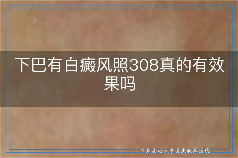 下巴有白癜风照308真的有效果吗