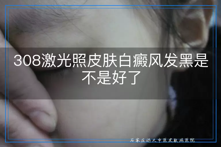 308激光照皮肤白癜风发黑是不是好了
