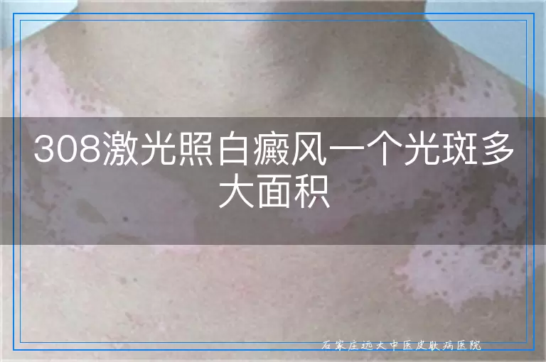 308激光照白癜风一个光斑多大面积