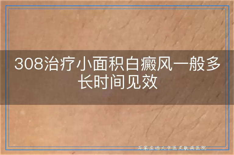 308治疗小面积白癜风一般多长时间见效