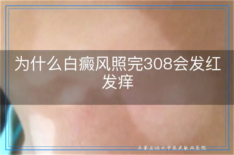 为什么白癜风照完308会发红发痒