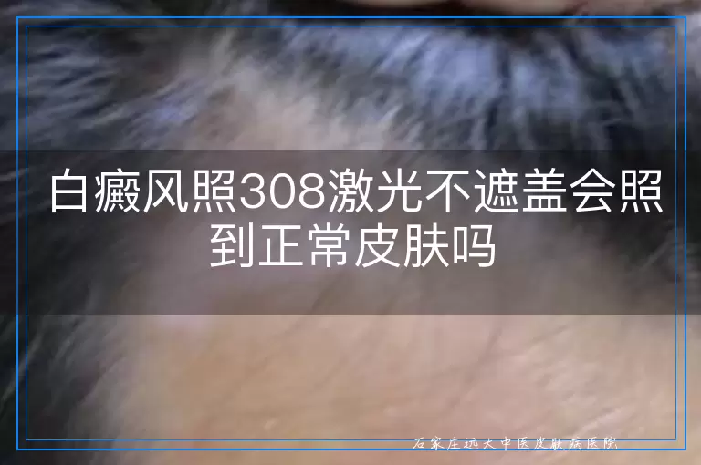 白癜风照308激光不遮盖会照到正常皮肤吗