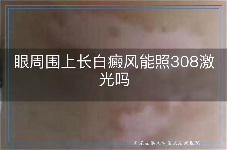 眼周围上长白癜风能照308激光吗