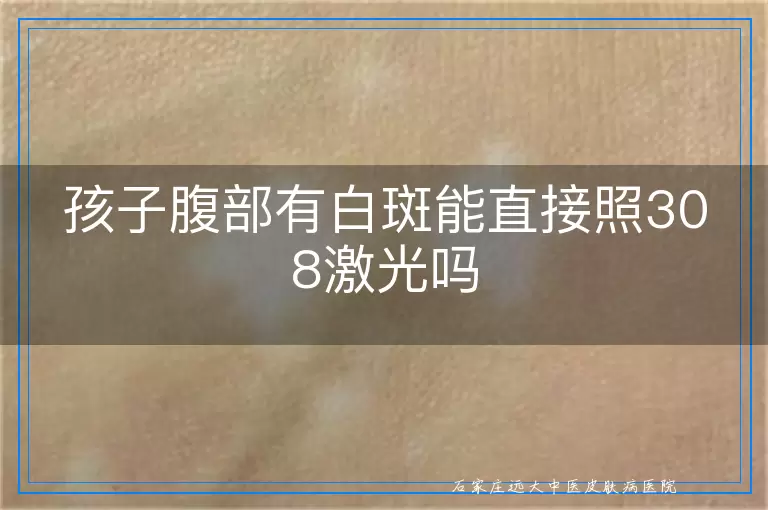 孩子腹部有白斑能直接照308激光吗