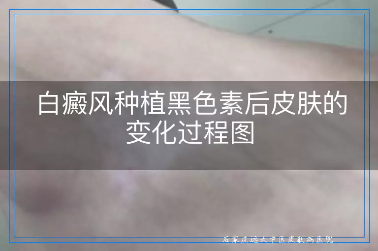 白癜风种植黑色素后皮肤的变化过程图