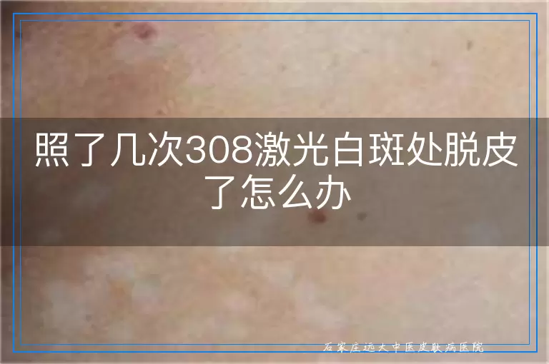 照了几次308激光白斑处脱皮了怎么办