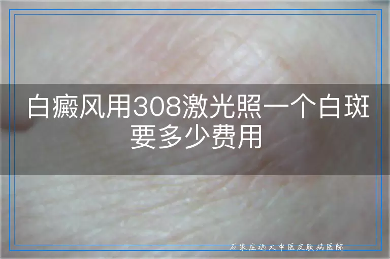白癜风用308激光照一个白斑要多少费用
