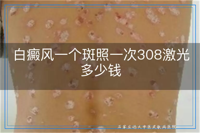 白癜风一个斑照一次308激光多少钱