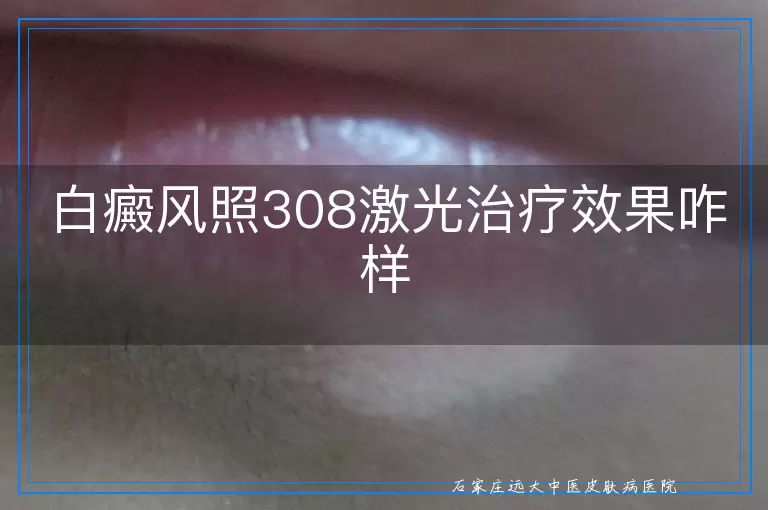 白癜风照308激光治疗效果咋样