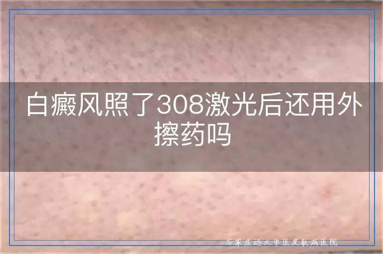 白癜风照了308激光后还用外擦药吗