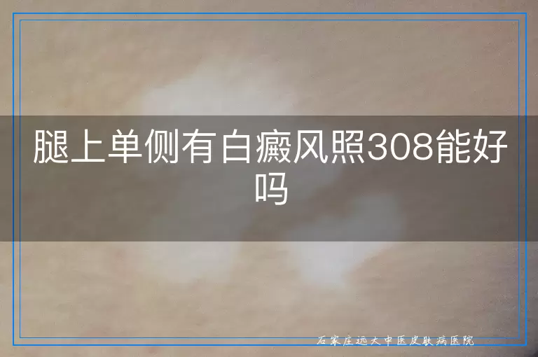 腿上单侧有白癜风照308能好吗