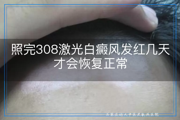 照完308激光白癜风发红几天才会恢复正常