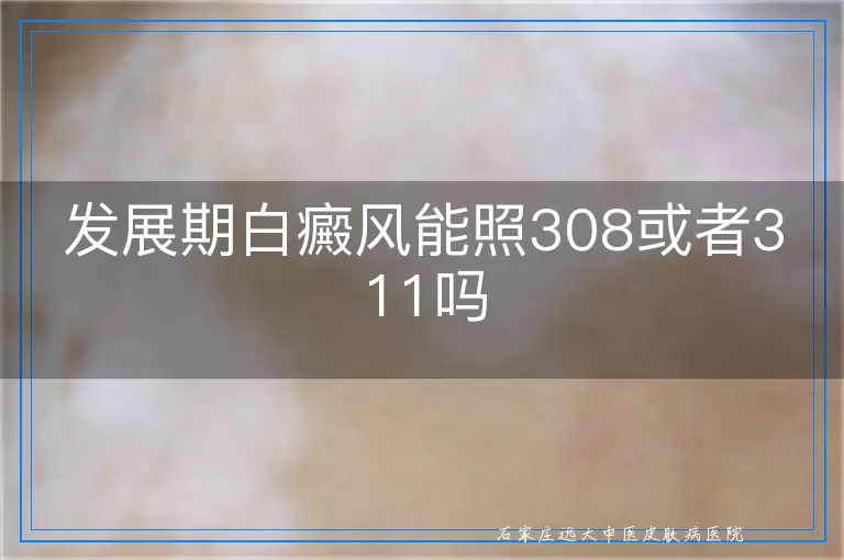 发展期白癜风能照308或者311吗