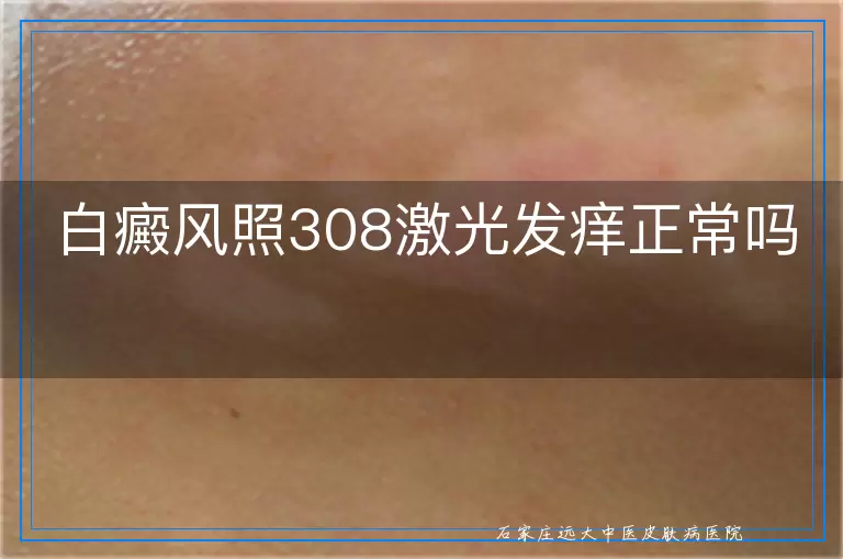白癜风照308激光发痒正常吗