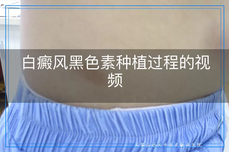 白癜风黑色素种植过程的视频