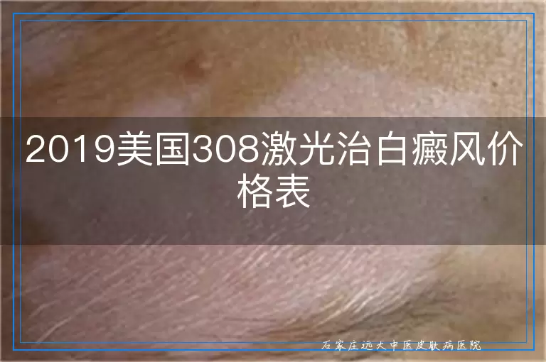 2019美国308激光治白癜风价格表