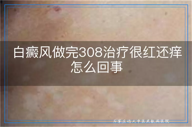白癜风做完308治疗很红还痒怎么回事