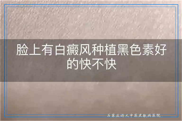 脸上有白癜风种植黑色素好的快不快
