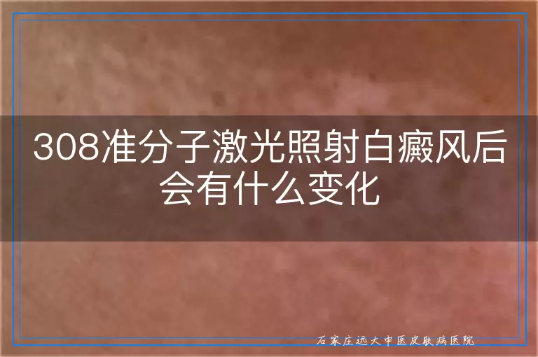 308准分子激光照射白癜风后会有什么变化